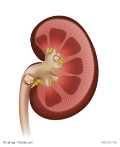 foods that trigger kidney stones foods that trigger kidney stones