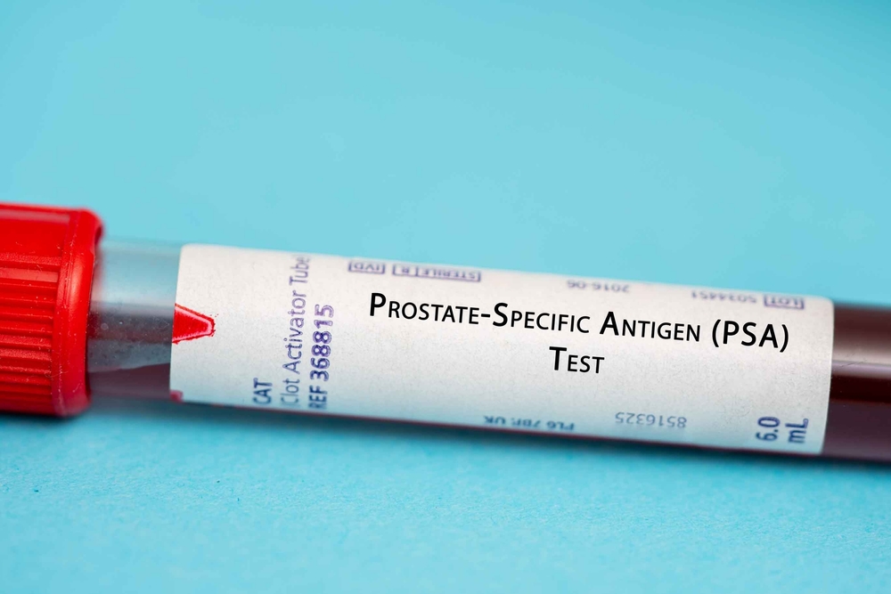 Prostate-Specific Antigen (PSA) Test.