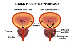 benign prostatic hyperplasia (BPH)