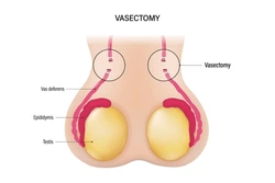 Vasectomy
