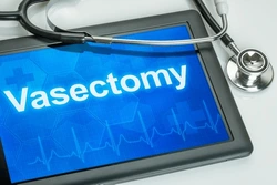 Vasectomy